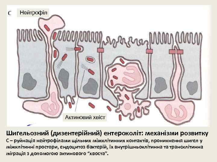 Нейтрофіл Актиновий хвіст Шигельозний (дизентерійний) ентероколіт: механізми розвитку С – руйнація нейтрофілами щільних міжклітинних