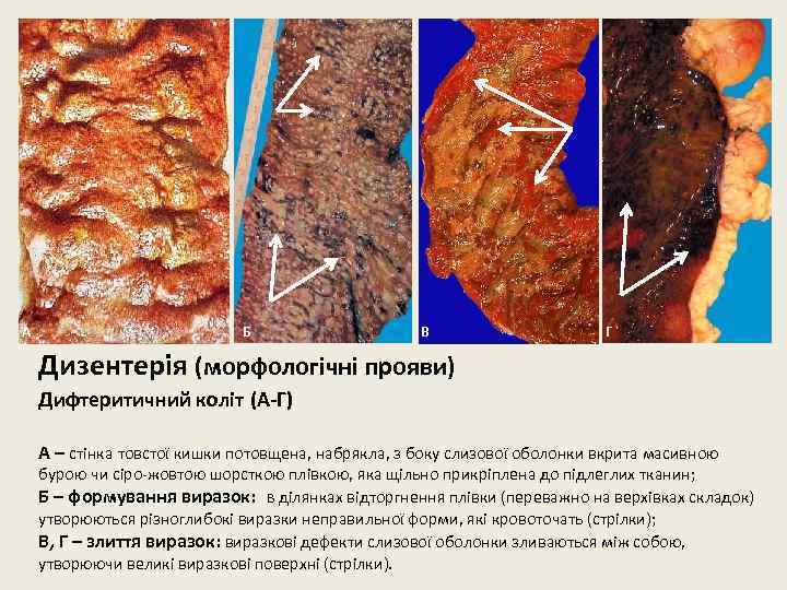 А Б В Г Дизентерія (морфологічні прояви) Дифтеритичний коліт (А-Г) А – стінка товстої
