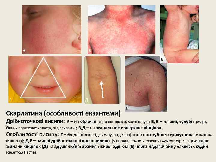 А Б В Г Д Скарлатина (особливості екзантеми) Е Дрібноточкові висипи: А – на