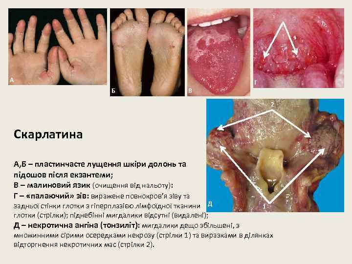 А Б В Г 2 Скарлатина А, Б – пластинчасте лущення шкіри долонь та