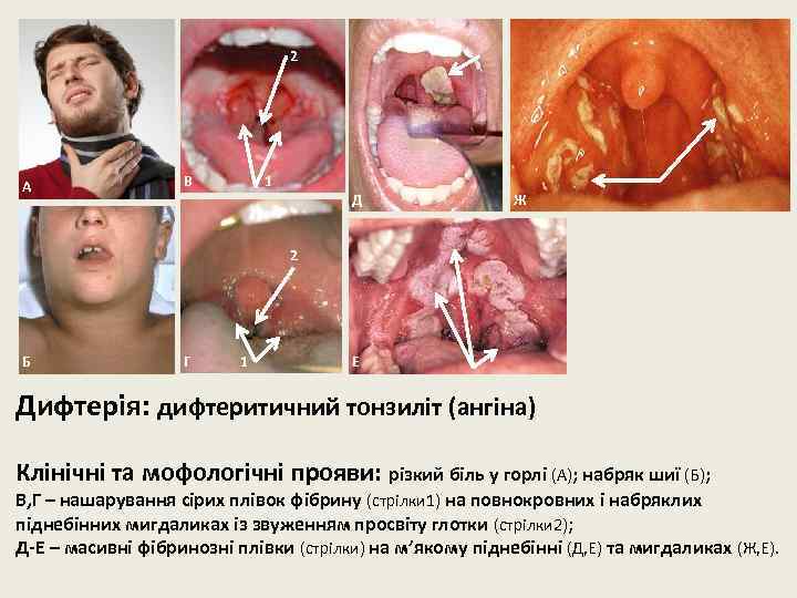 2 А В 1 Д Ж 2 Б Г 1 Е Дифтерія: дифтеритичний тонзиліт