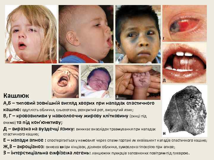 Г А Б В Д Кашлюк Е Ж З А, Б – типовий зовнішній