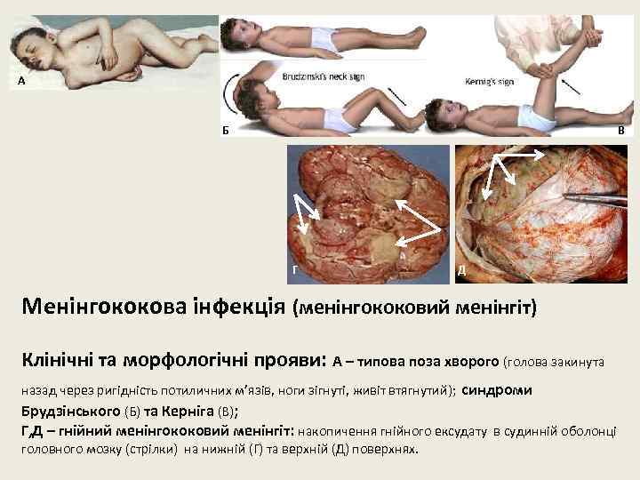 А Б В Г Д Менінгококова інфекція (менінгококовий менінгіт) Клінічні та морфологічні прояви: А