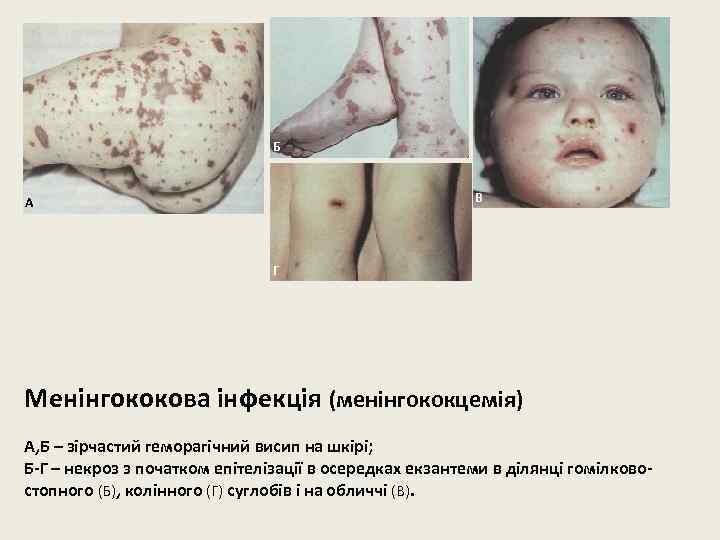 Б В А Г Менінгококова інфекція (менінгококцемія) А, Б – зірчастий геморагічний висип на