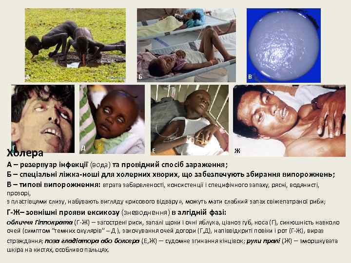 А Г Холера Б Д В Е Ж А – резервуар інфекції (вода) та