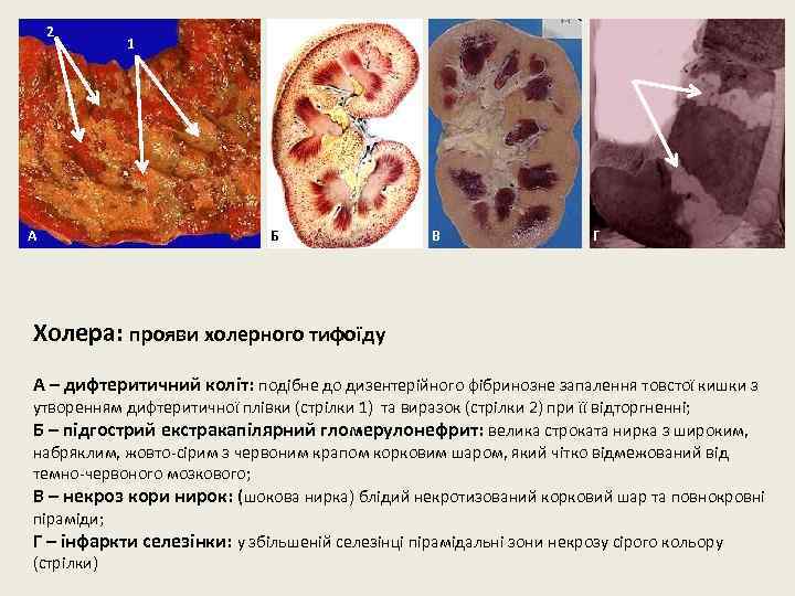 2 А 1 Б В Г Холера: прояви холерного тифоїду А – дифтеритичний коліт: