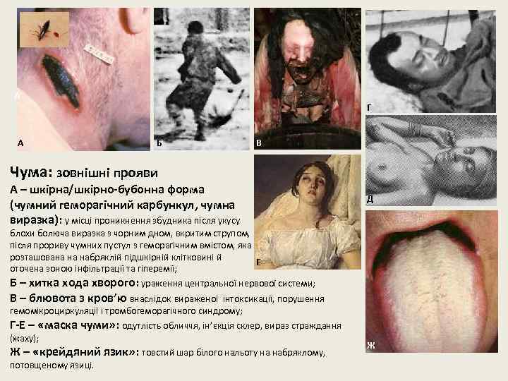 А А Г Б В Чума: зовнішні прояви А – шкірна/шкірно-бубонна форма (чумний геморагічний