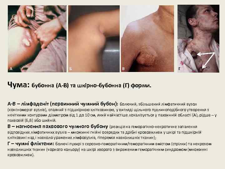 А Б В Г Чума: бубонна (А-В) та шкірно-бубонна (Г) форми. А-В – лімфаденіт