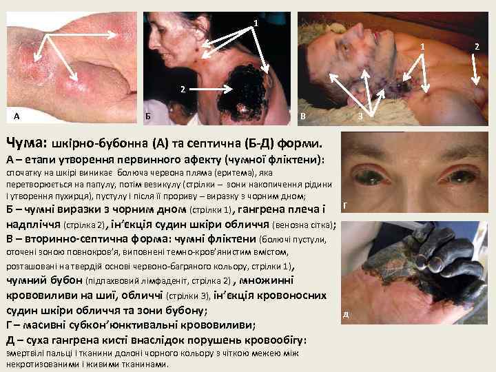 1 1 2 А Б В 3 Чума: шкірно-бубонна (А) та септична (Б-Д) форми.