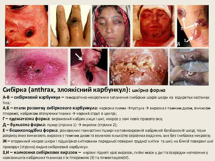 2 А Е Б В Ж Г З Д 1 И Сибірка (anthrax, злоякісний