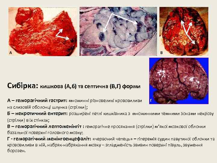 А Б В Сибірка: кишкова (А, б) та септична (В, Г) форми А –