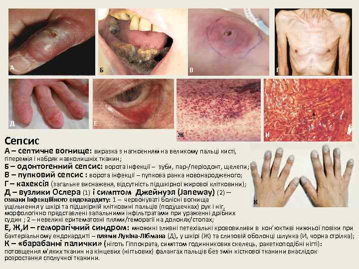 А Д Сепсис Б В Г Е Ж А – септичне вогнище: виразка з