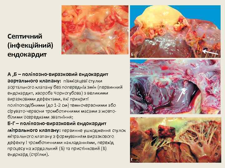 Септичний (інфекційний) ендокардит А Б А , Б – поліпозно-виразковий ендокардит аортального клапану: півмісяцеві
