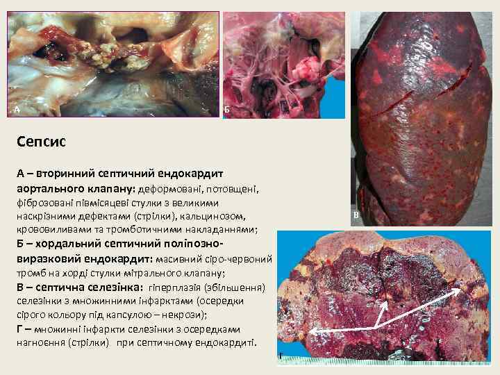 А Б Сепсис А – вторинний септичний ендокардит аортального клапану: деформовані, потовщені, фіброзовані півмісяцеві