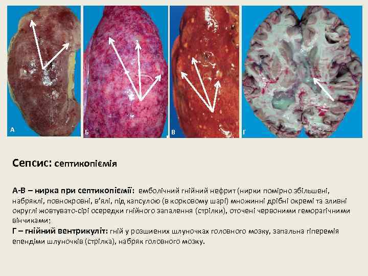 А Б В Г Сепсис: септикопіємія А-В – нирка при септикопіємії: емболічний гнійний нефрит