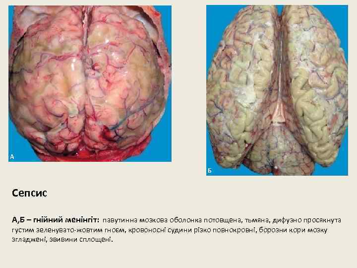 А Б Сепсис А, Б – гнійний менінгіт: павутинна мозкова оболонка потовщена, тьмяна, дифузно