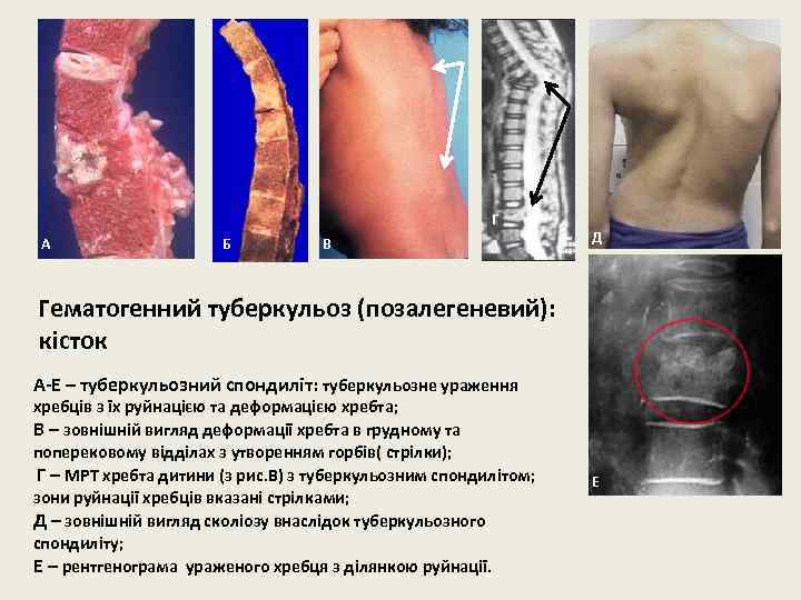 Г А Б В Д Гематогенний туберкульоз (позалегеневий): кісток А-Е – туберкульозний спондиліт: туберкульозне