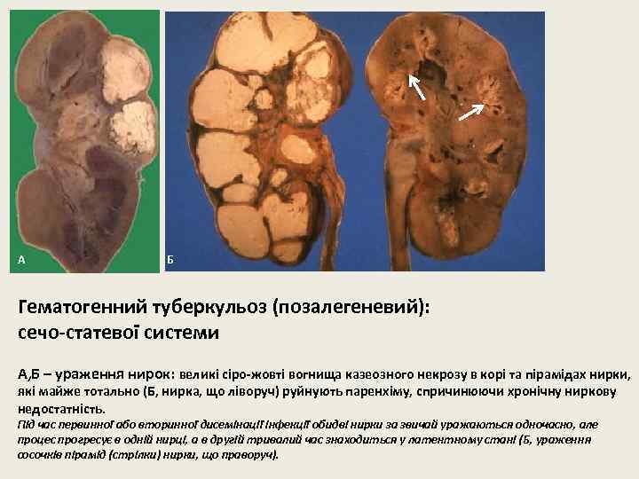 А Б Гематогенний туберкульоз (позалегеневий): сечо-статевої системи А, Б – ураження нирок: великі сіро-жовті