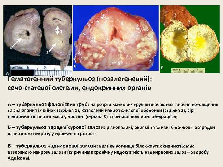 1 2 3 Б А В Гематогенний туберкульоз (позалегеневий): сечо-статевої системи, ендокринних органів А
