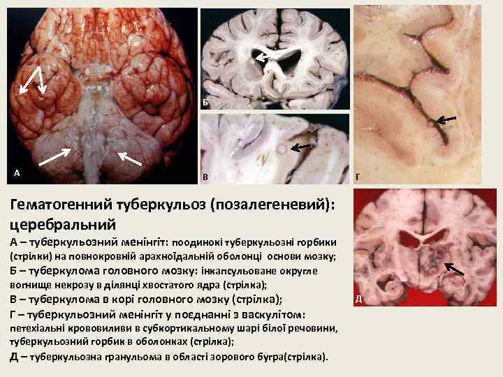 Б А В Г Гематогенний туберкульоз (позалегеневий): церебральний А – туберкульозний менінгіт: поодинокі туберкульозні