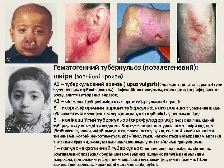 А 1 Б В Г Гематогенний туберкульоз (позалегеневий): шкіри (зовнішні прояви) А 1 –