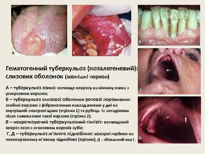 2 1 А В Б Гематогенний туберкульоз (позалегеневий): слизових оболонок (зовнішні поряви) А –