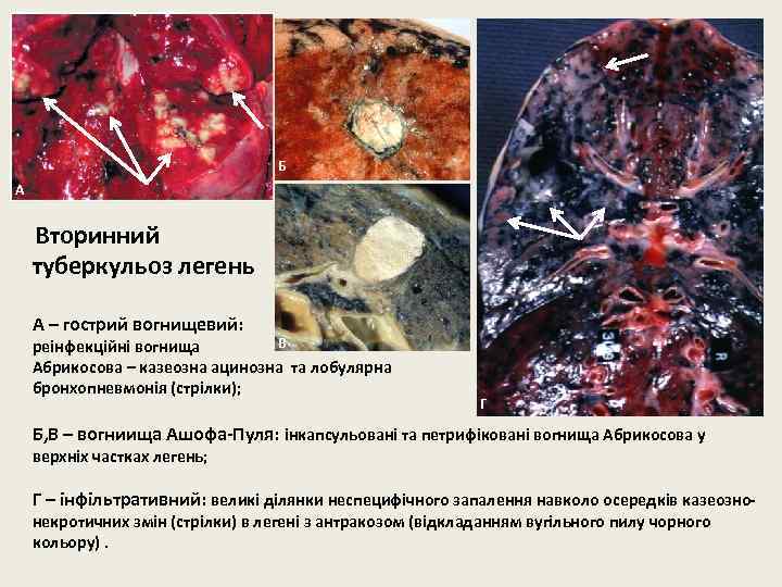 Б А Вторинний туберкульоз легень А – гострий вогнищевий: В реінфекційні вогнища Абрикосова –