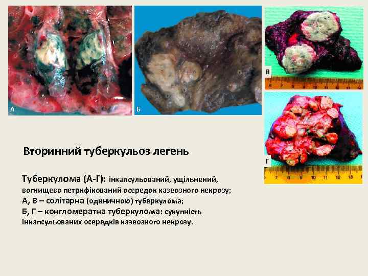 В А Б Вторинний туберкульоз легень Туберкулома (А-Г): інкапсульований, ущільнений, вогнищево петрифікований осередок казеозного