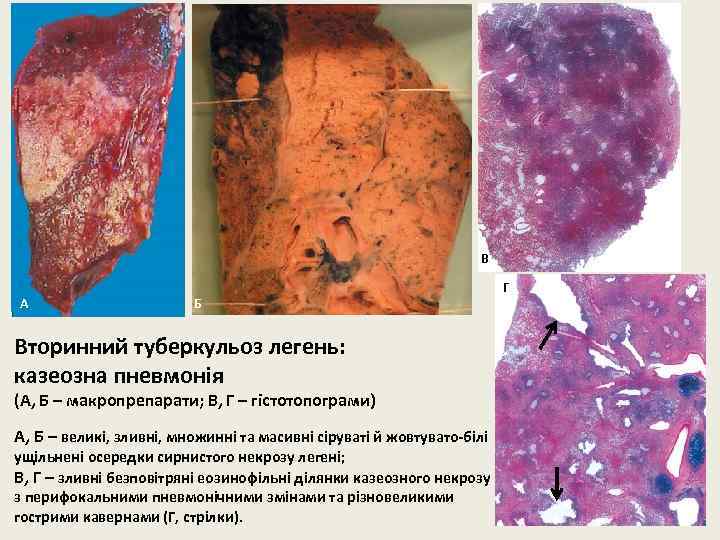 В А Б Вторинний туберкульоз легень: казеозна пневмонія (А, Б – макропрепарати; В, Г