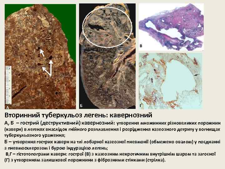 В А Б Г Вторинний туберкульоз легень: кавернозний А, Б – гострий (деструктивний) кавернозний: