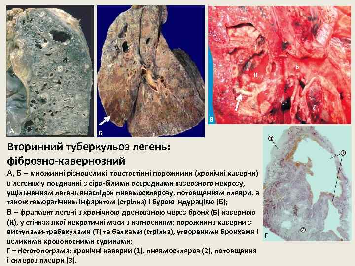 Т К В А Б Вторинний туберкульоз легень: фіброзно-кавернозний А, Б – множинні різновеликі