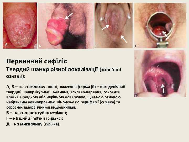 А Б В Г Первинний сифіліс Твердий шанкр різної локалізації (зовнішні ознаки): А, Б