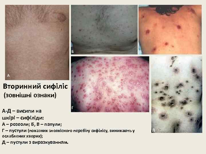 Б В А Вторинний сифіліс (зовнішні ознаки) А-Д – висипи на шкірі – сифіліди: