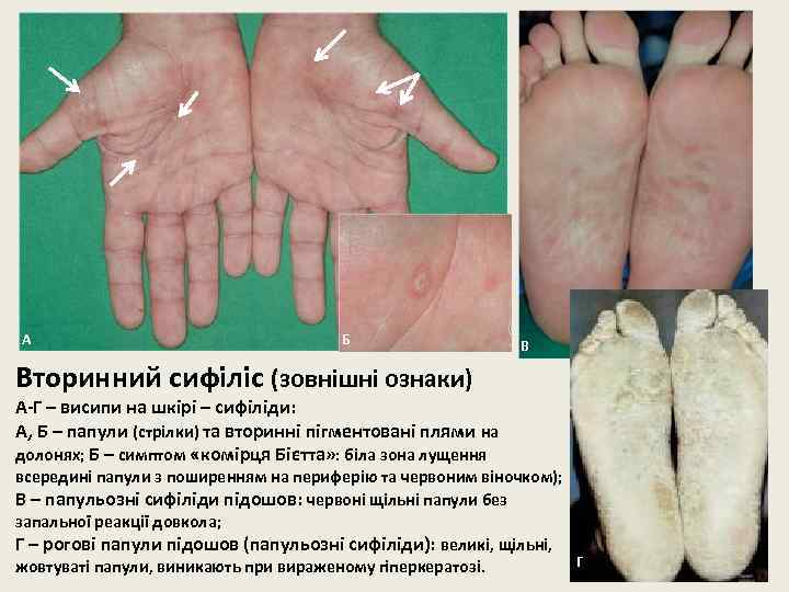 А Б В Вторинний сифіліс (зовнішні ознаки) А-Г – висипи на шкірі – сифіліди: