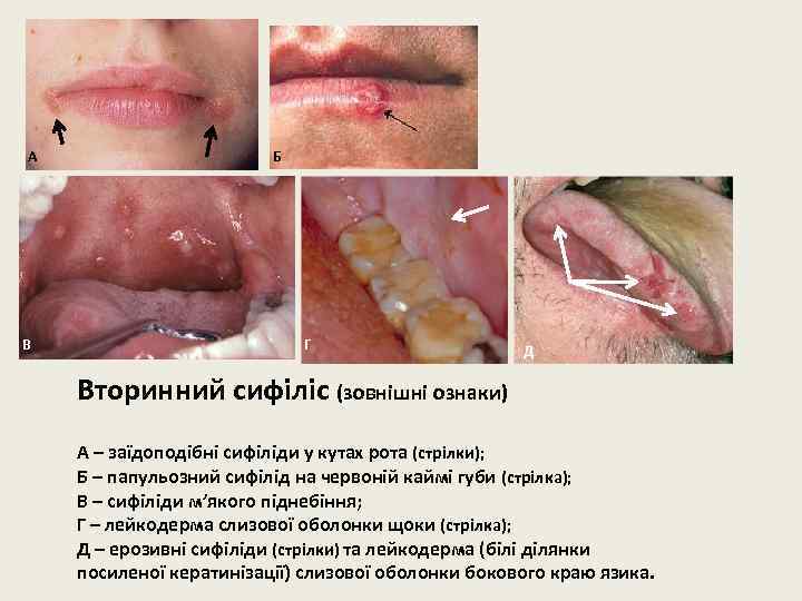 А В Б Г Д Вторинний сифіліс (зовнішні ознаки) А – заїдоподібні сифіліди у