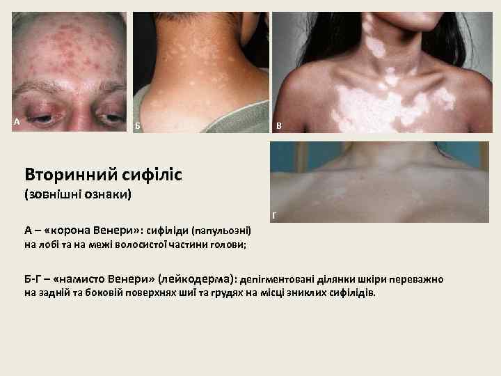 А Б В Вторинний сифіліс (зовнішні ознаки) Г А – «корона Венери» : сифіліди
