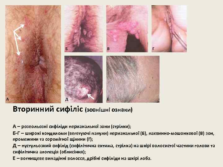 Б А В Д Г Е Вторинний сифіліс (зовнішні ознаки) А – розеольозні сифіліди
