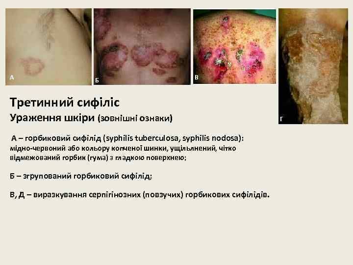 А Б В Третинний сифіліс Ураження шкіри (зовнішні ознаки) А – горбиковий сифілід (syphilis