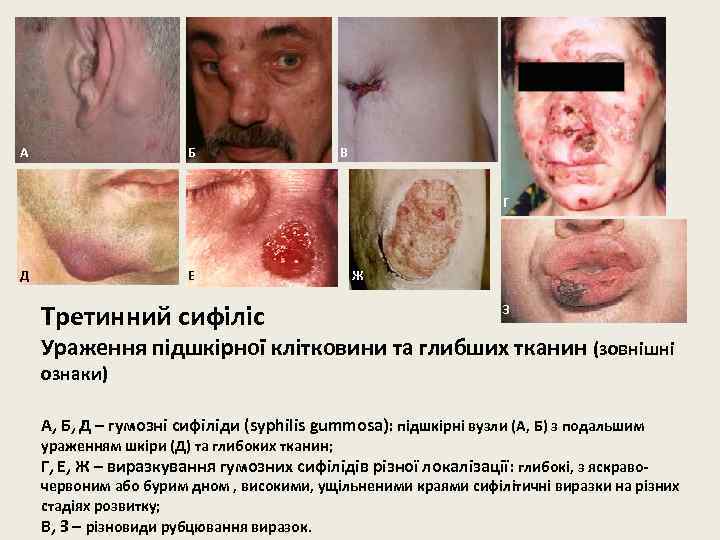 А Б В Г Д Е Третинний сифіліс Ж З Ураження підшкірної клітковини та