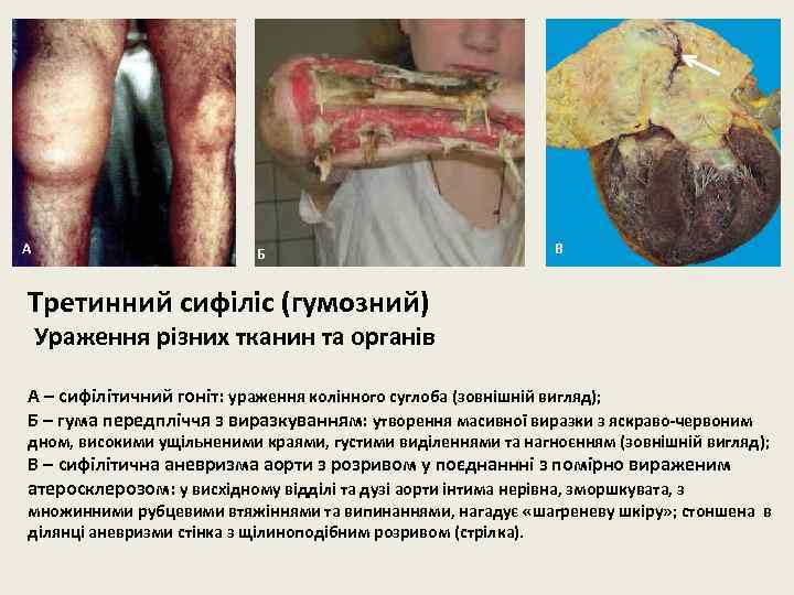 А Б В Третинний сифіліс (гумозний) Ураження різних тканин та органів А – сифілітичний