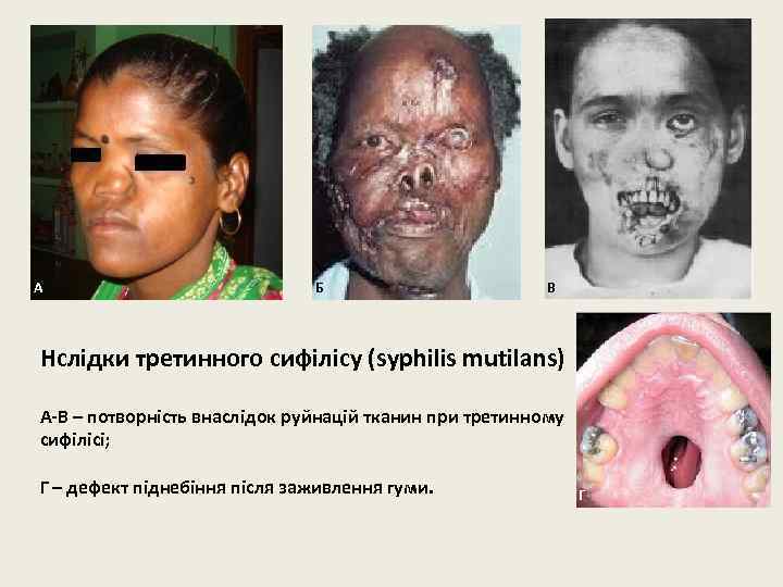 А Б В Нслідки третинного сифілісу (syphilis mutilans) А-В – потворність внаслідок руйнацій тканин