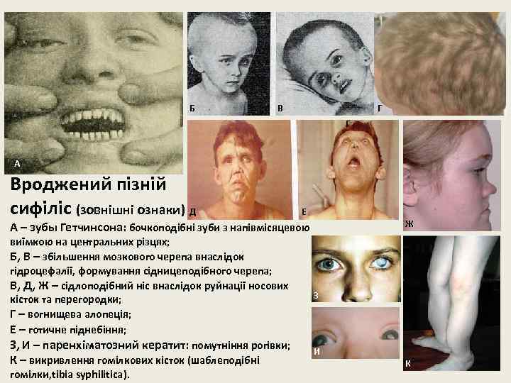 Б В Г Г А Вроджений пізній сифіліс (зовнішні ознаки) Д Е Ж А