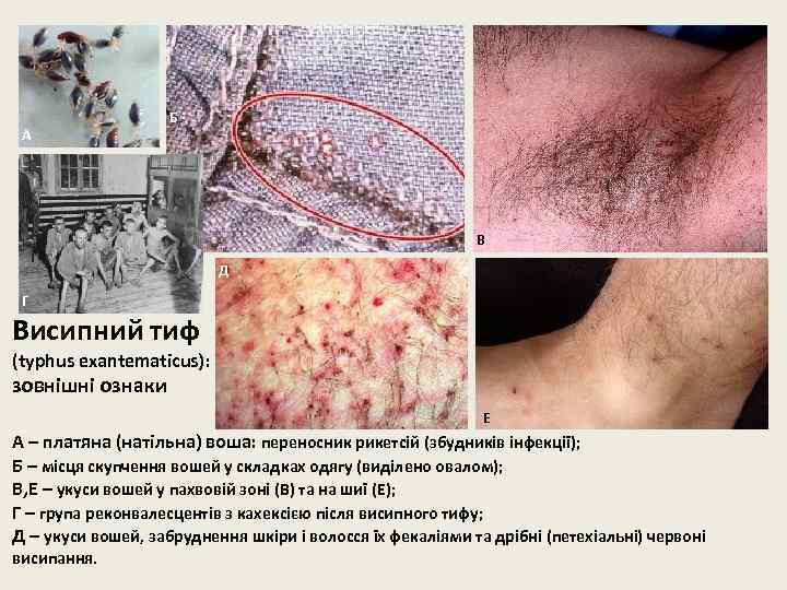А Б В Д Г Висипний тиф (typhus exantematicus): зовнішні ознаки Е А –