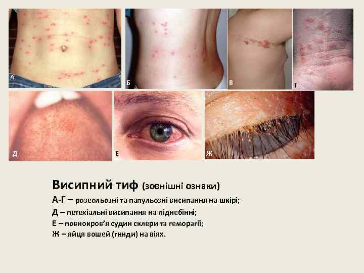 А Д Б Е В Ж Висипний тиф (зовнішні ознаки) А-Г – розеольозні та