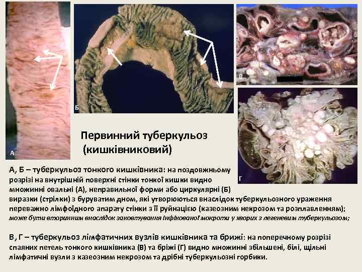 В Б Первинний туберкульоз (кишківниковий) А А, Б – туберкульоз тонкого кишківника: на поздовжньому