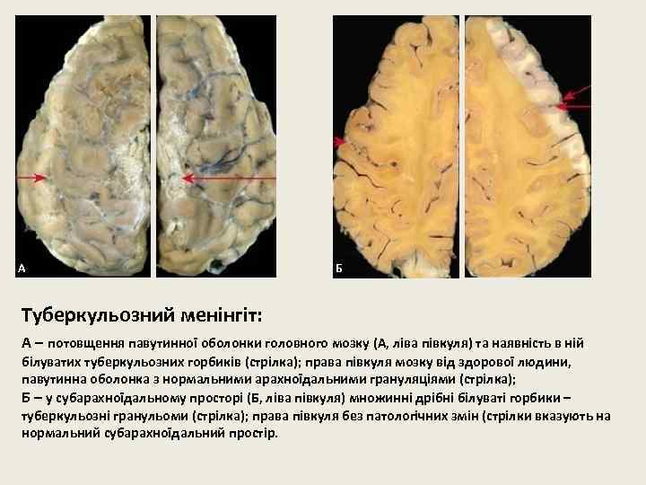 А Б Туберкульозний менінгіт: А – потовщення павутинної оболонки головного мозку (А, ліва півкуля)