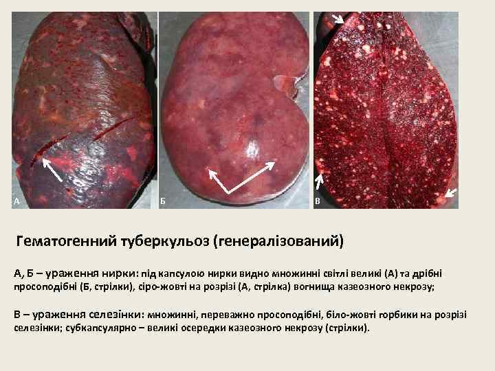 А Б В Гематогенний туберкульоз (генералізований) А, Б – ураження нирки: під капсулою нирки