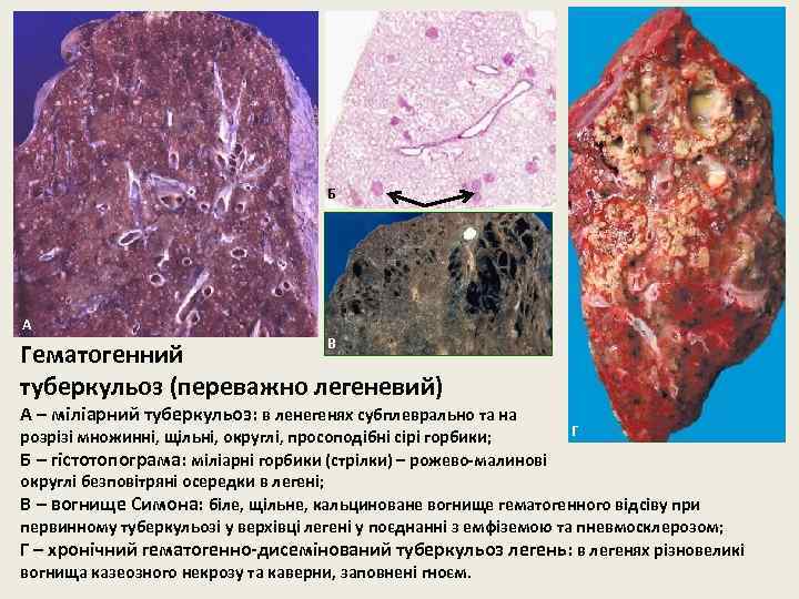 Б А В Гематогенний туберкульоз (переважно легеневий) А – міліарний туберкульоз: в ленегенях субплеврально