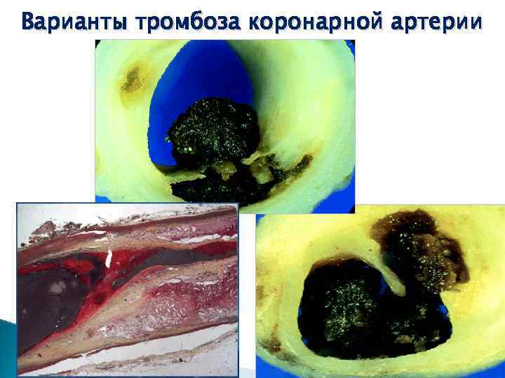 Варианты тромбоза коронарной артерии 