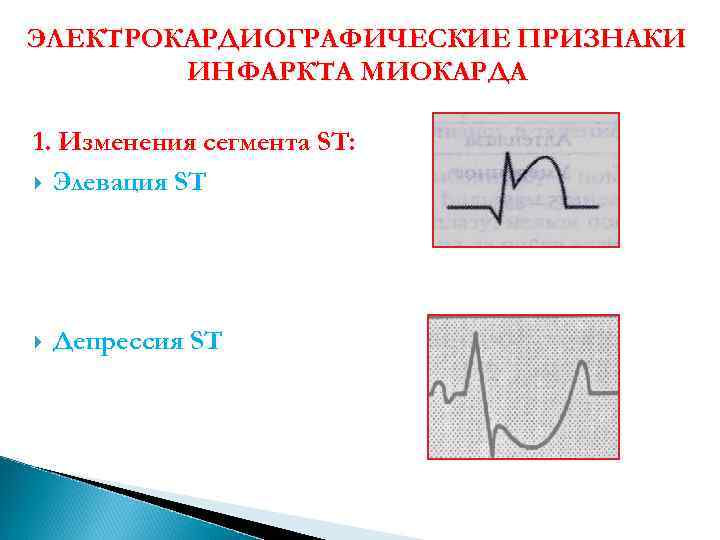 ЭЛЕКТРОКАРДИОГРАФИЧЕСКИЕ ПРИЗНАКИ ИНФАРКТА МИОКАРДА 1. Изменения сегмента ST: Элевация ST Депрессия ST 